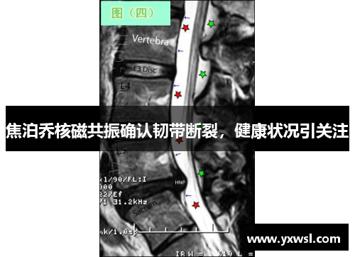 焦泊乔核磁共振确认韧带断裂，健康状况引关注